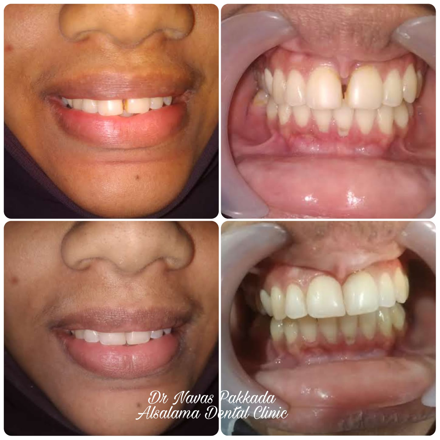 Midline diastema closure